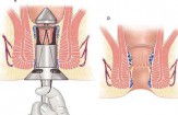 Chi phí cắt trĩ hết bao nhiêu tiền bảng giá chữa bệnh trĩ