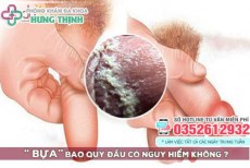 Bao quy đầu có bựa trắng, dương vật xuất hiện mảng trắng có sao không