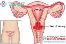 9 Cách chữa viêm cổ tử cung tại nhà hiệu quả ở nữ giới