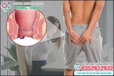 11 Cách làm co búi trĩ ngoại tại nhà teo xẹp trĩ nhanh