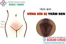 22 Hình ảnh cô bé bị thâm đen và cách khắc phục
