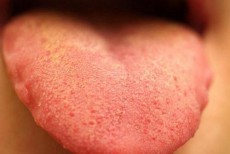 Tổng hợp 10 Hình ảnh gai lưỡi bình thường và cách chữa