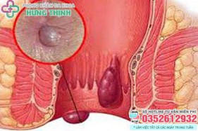 10 Bệnh viện, phòng khám chữa bệnh trĩ ở đâu tốt nhất Hà Nội