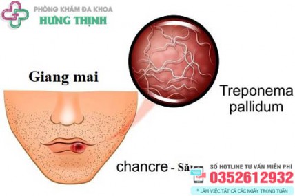 Bệnh giang mai ở miệng, lưỡi: Triệu chứng, hình ảnh, cách chữa