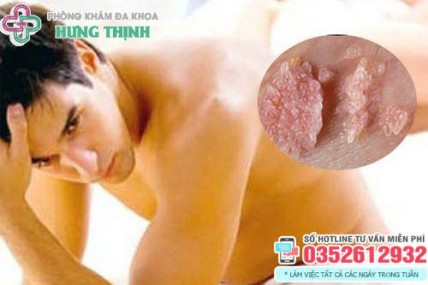 10 Địa chỉ xét nghiệm khám chữa sùi mào gà ở đâu tốt Hà Nội
