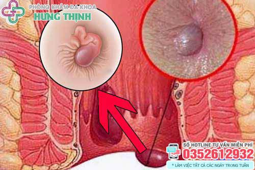 12 Cách chữa bệnh trĩ ngoại, trĩ nội tại nhà hiệu quả nhanh nhất